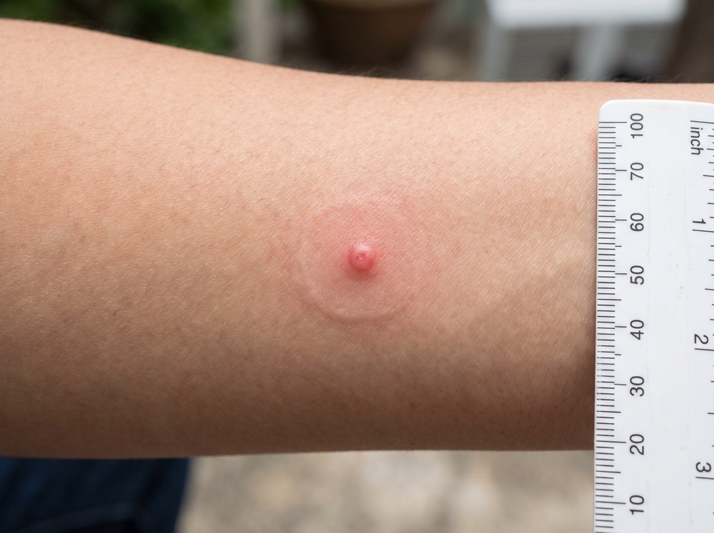 Macro close-up photograph of a fresh spider wasp sting mark on skin showing a small red puncture with mild surrounding swelling